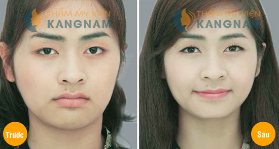 Tạo má lúm đồng tiền877