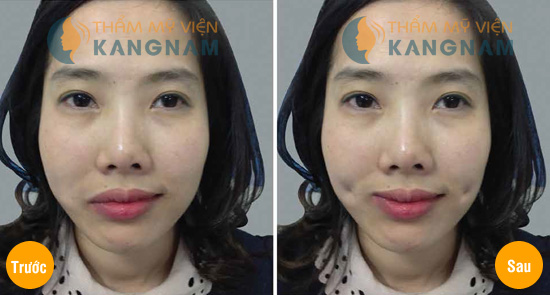 Cho tôi hỏi: giá tạo má lúm có đắt không?4