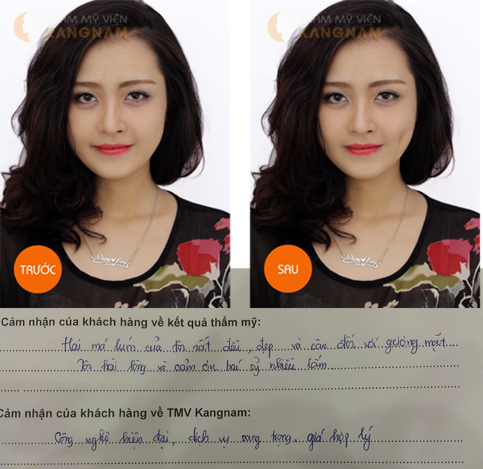 Tư vấn giúp tôi: sau tạo má lúm có để lại sẹo không?4