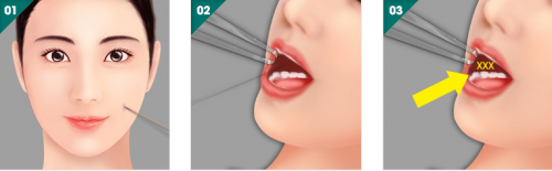 Làm má lúm đồng tiền có đau lắm không 2