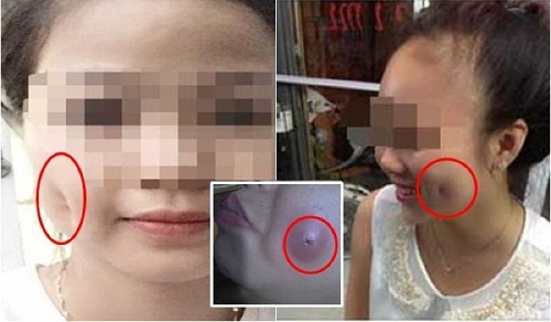 Tạo má lúm đồng tiền giá rẻ và biến chứng nhận lại tao-ma-lum-dong-tien-gia-re-2