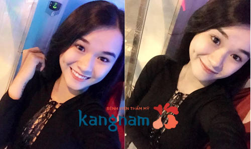 kinh nghiệm tạo má lúm đồng tiền 3