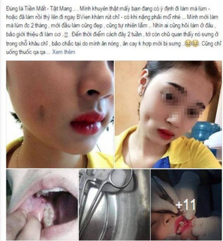Phẫu thuật má lúm hỏng1