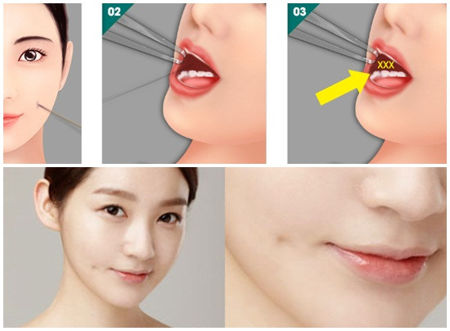 sửa má lúm đồng tiền 1