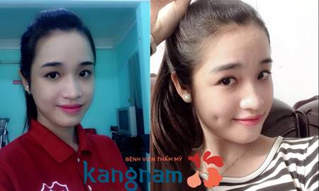 sửa má lúm đồng tiền 2