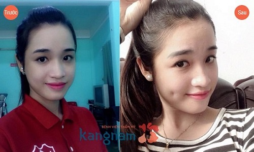 Đôi má lúm được tạo ra nhờ công nghệ Hàn Quốc má lúm đồng tiền 2 bên 10