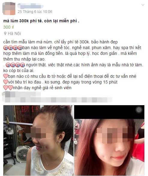 Tạo má lúm đồng tiền giá rẻ và cái giá “thực” phải trả