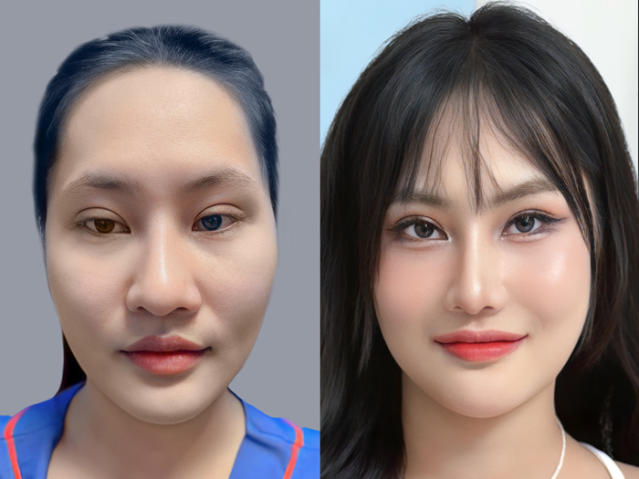 Kết quả hạ gò má của khách hàng